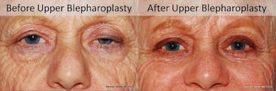 Blepharoplasty Before & After Gallery - Patient 419854 - Image 1