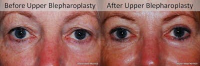 Blepharoplasty Before & After Gallery - Patient 216601 - Image 1