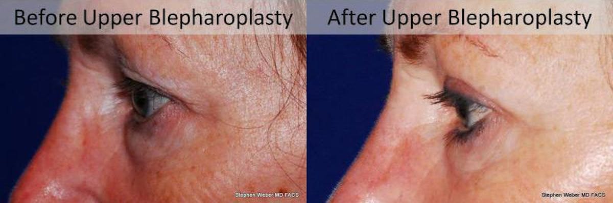 Blepharoplasty Before & After Gallery - Patient 216601 - Image 2