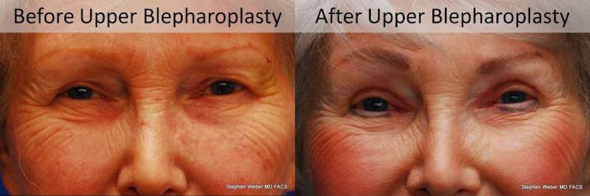 Blepharoplasty Before & After Gallery - Patient 253452 - Image 1