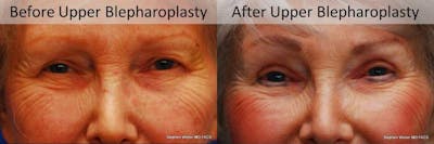 Blepharoplasty Before & After Gallery - Patient 253452 - Image 1