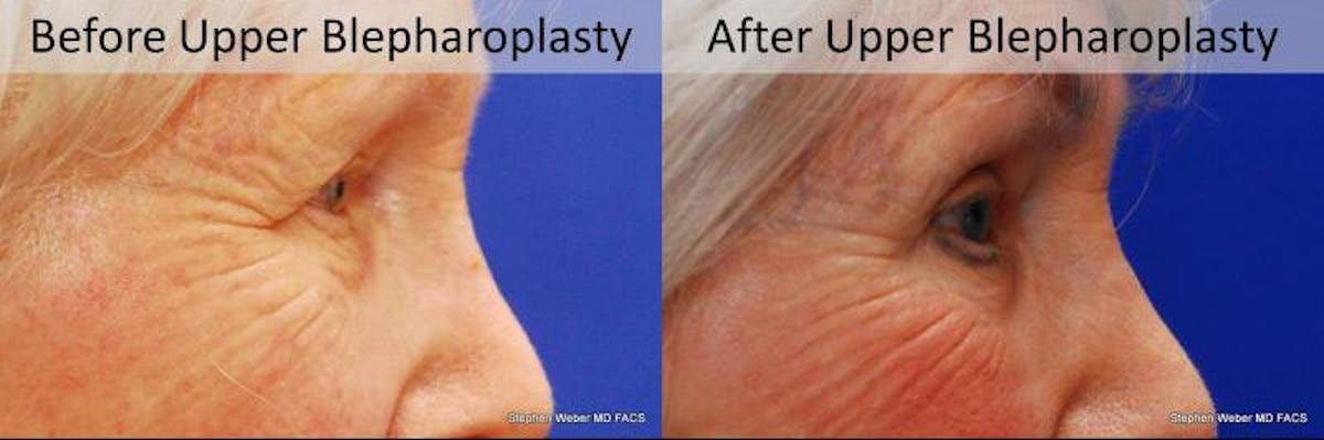 Blepharoplasty Before & After Gallery - Patient 253452 - Image 2