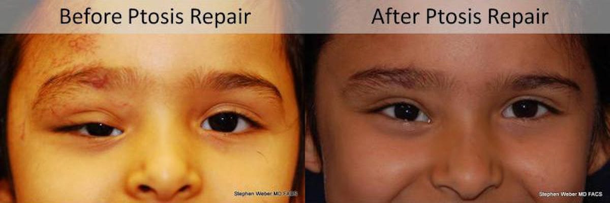 Blepharoplasty Before & After Gallery - Patient 140429 - Image 1