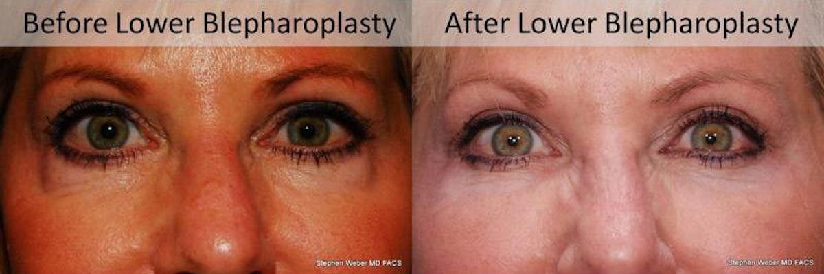 Blepharoplasty Before & After Gallery - Patient 201840 - Image 1