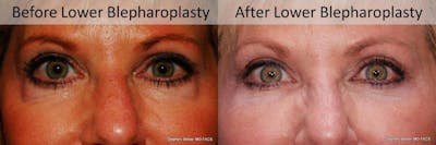 Blepharoplasty Before & After Gallery - Patient 201840 - Image 1
