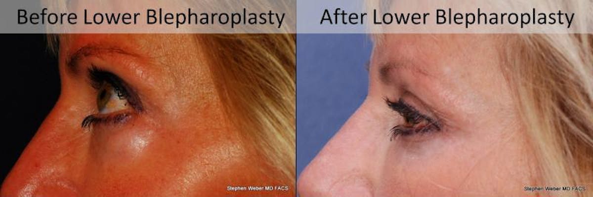 Blepharoplasty Before & After Gallery - Patient 201840 - Image 2