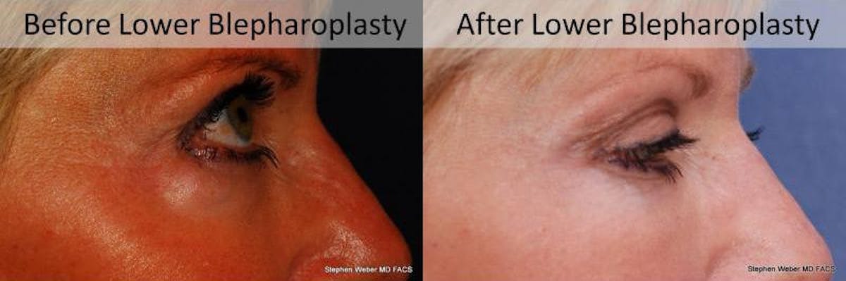 Blepharoplasty Before & After Gallery - Patient 201840 - Image 3
