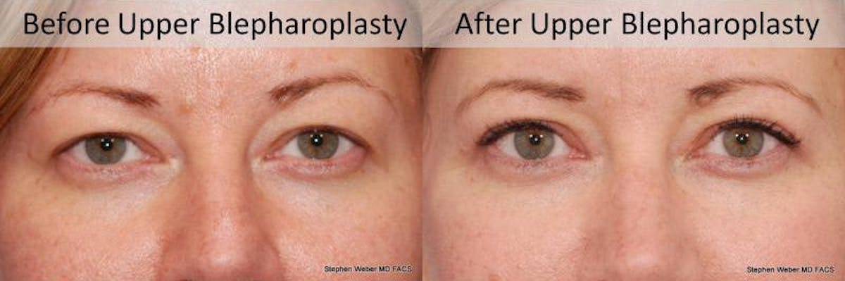 Blepharoplasty Before & After Gallery - Patient 337871 - Image 1