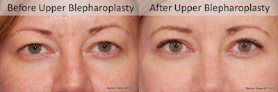 Blepharoplasty Before & After Gallery - Patient 337871 - Image 1