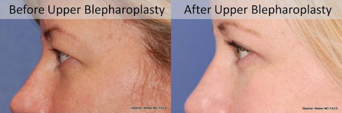 Blepharoplasty Before & After Gallery - Patient 337871 - Image 2