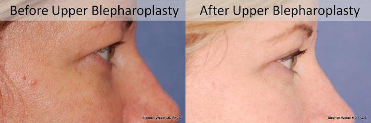 Blepharoplasty Before & After Gallery - Patient 337871 - Image 3