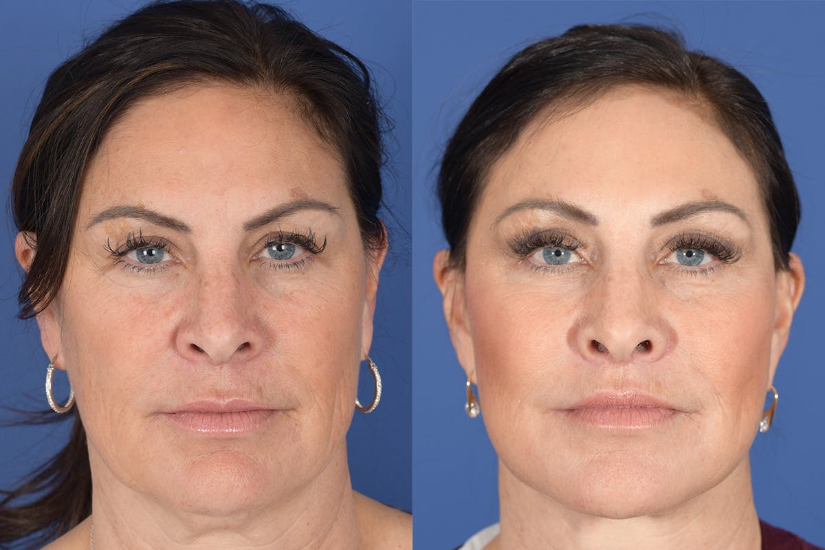Brow Lift Before & After Gallery - Patient 325952 - Image 1