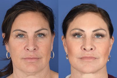 Facelift Before & After Gallery - Patient 128513 - Image 1