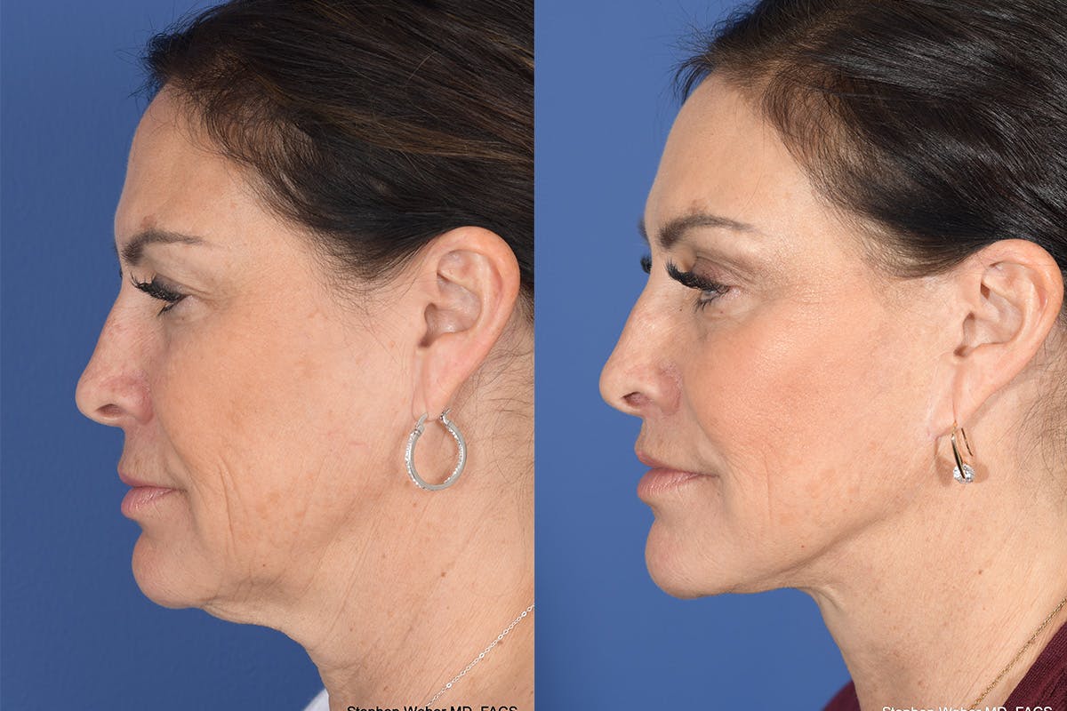 Brow Lift Before & After Gallery - Patient 325952 - Image 2