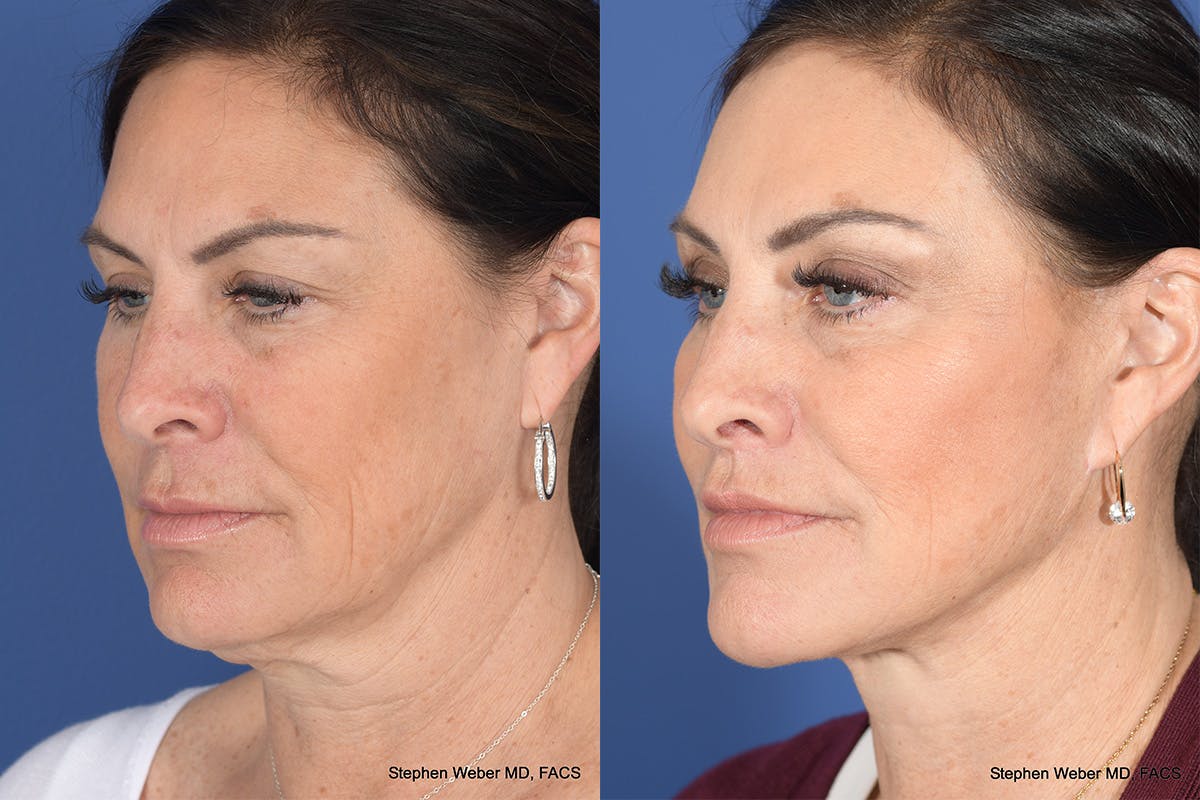 Brow Lift Before & After Gallery - Patient 325952 - Image 3