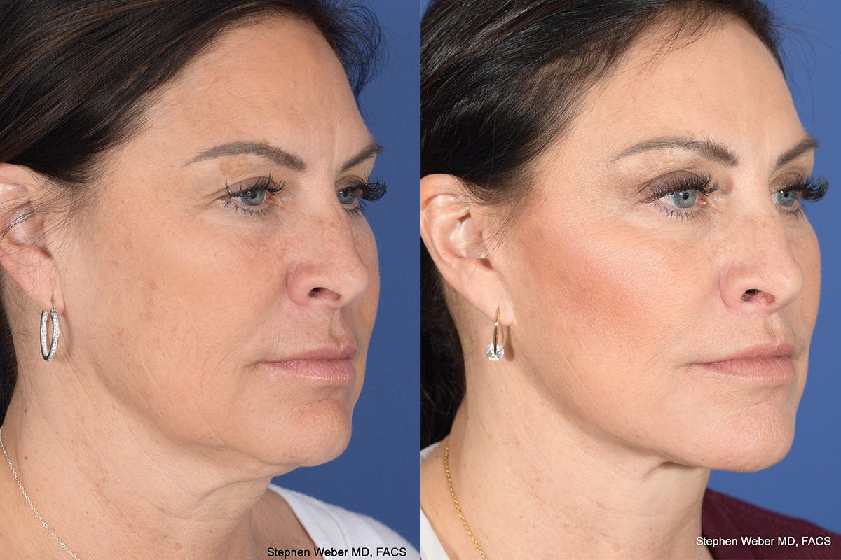 Brow Lift Before & After Gallery - Patient 325952 - Image 4
