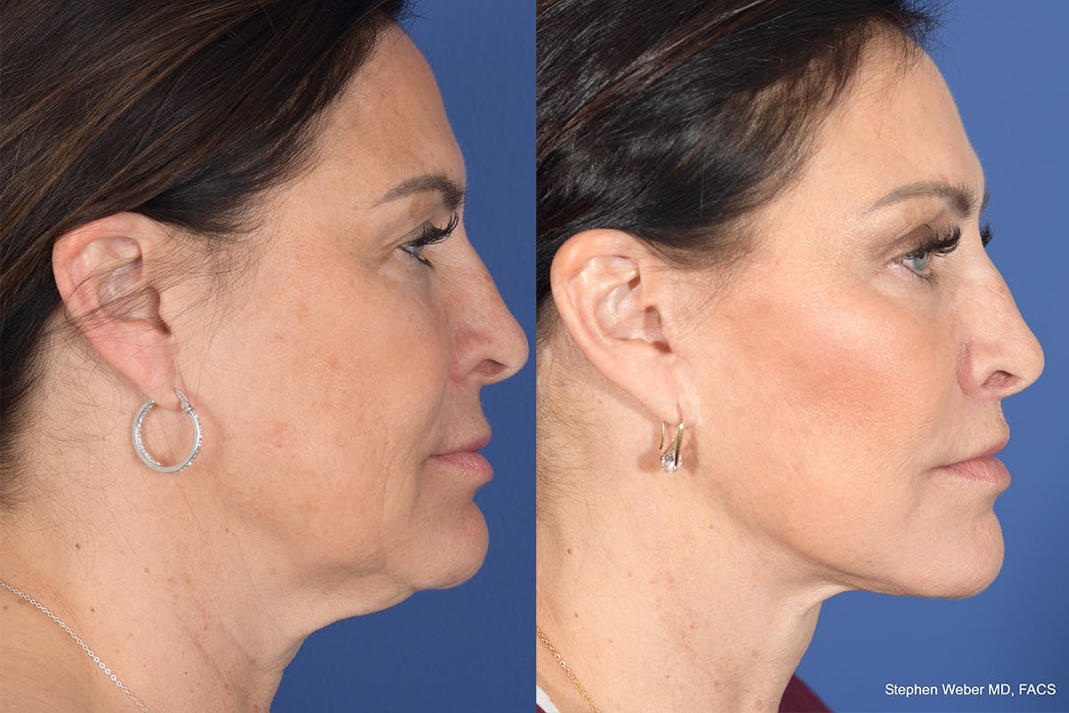 Brow Lift Before & After Gallery - Patient 325952 - Image 5