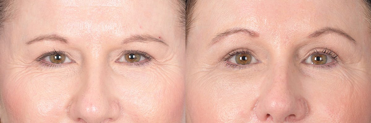 Brow Lift Before & After Gallery - Patient 190302 - Image 1