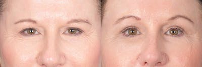 Brow Lift Before & After Gallery - Patient 190302 - Image 1