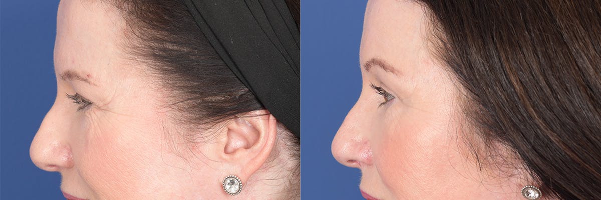 Brow Lift Before & After Gallery - Patient 190302 - Image 2