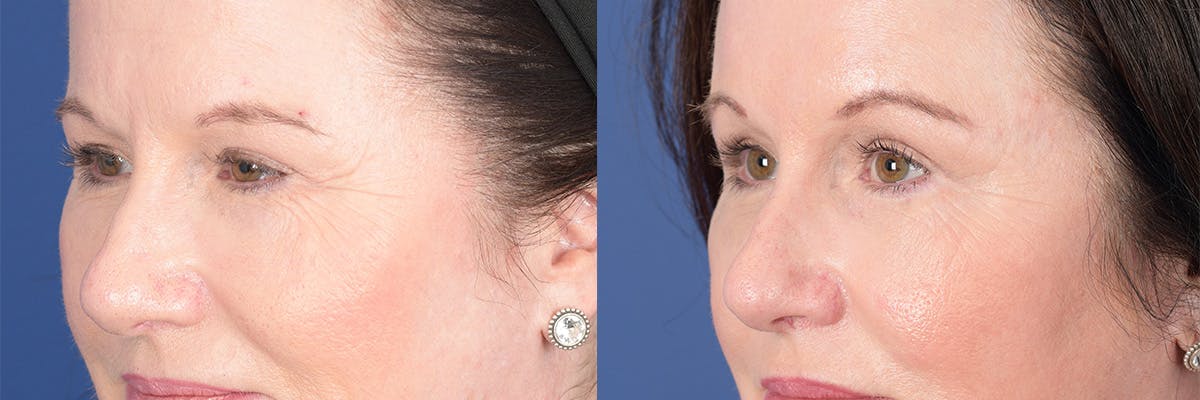 Brow Lift Before & After Gallery - Patient 190302 - Image 3