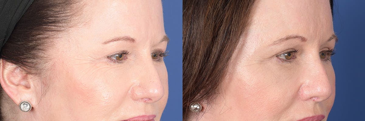 Brow Lift Before & After Gallery - Patient 190302 - Image 4
