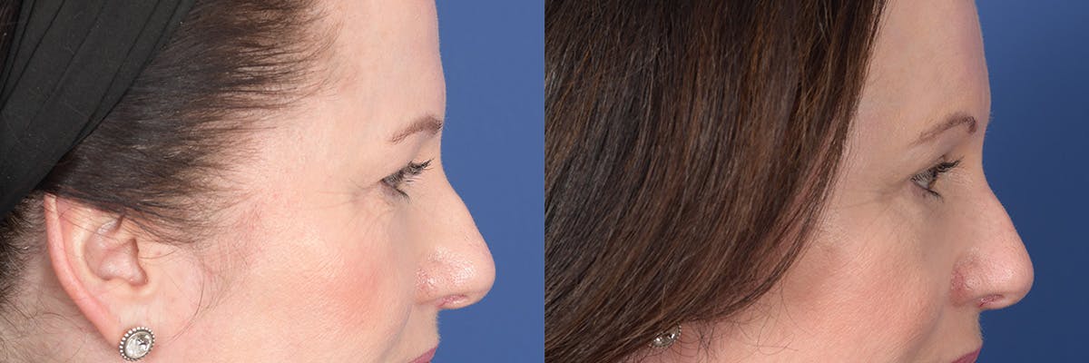 Brow Lift Before & After Gallery - Patient 190302 - Image 5