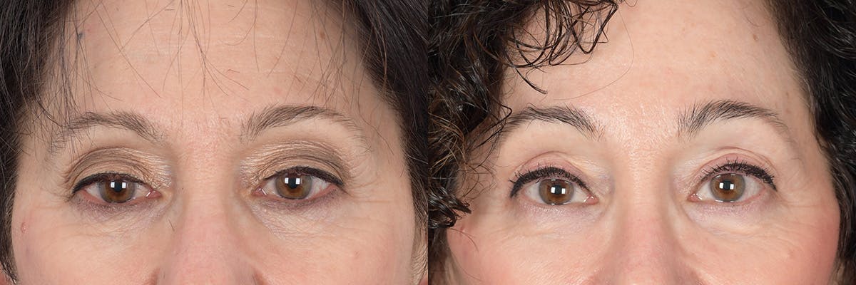 Brow Lift Before & After Gallery - Patient 277678 - Image 1