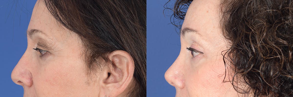 Brow Lift Before & After Gallery - Patient 277678 - Image 2