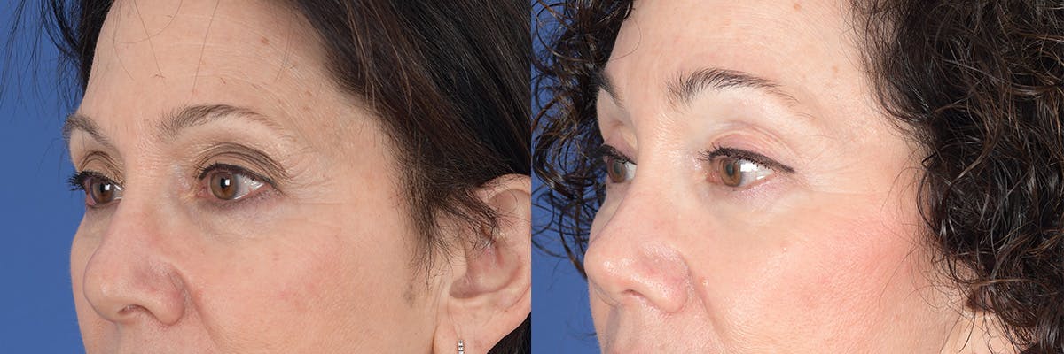 Brow Lift Before & After Gallery - Patient 277678 - Image 3