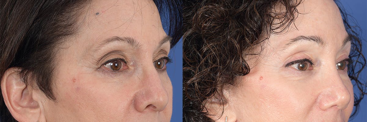 Brow Lift Before & After Gallery - Patient 277678 - Image 4