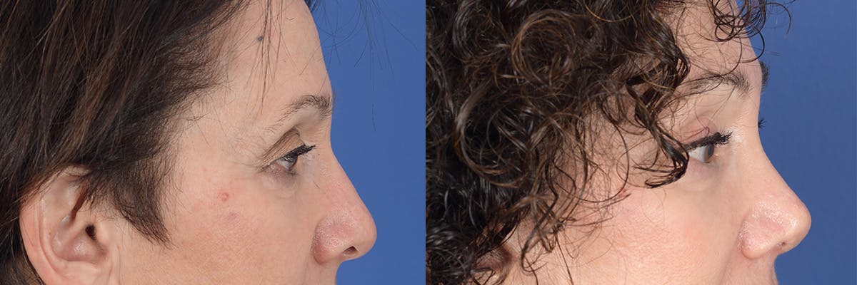Brow Lift Before & After Gallery - Patient 277678 - Image 5