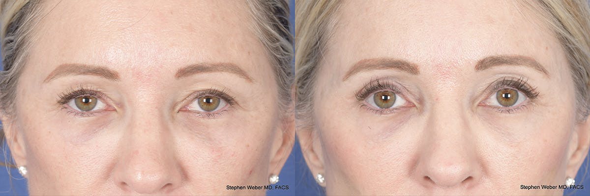 Brow Lift Before & After Gallery - Patient 160183 - Image 1