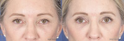 Brow Lift Before & After Gallery - Patient 160183 - Image 1