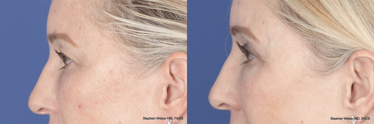 Brow Lift Before & After Gallery - Patient 160183 - Image 2