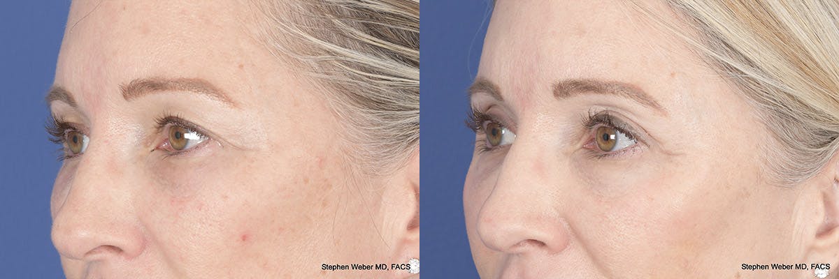 Brow Lift Before & After Gallery - Patient 160183 - Image 3