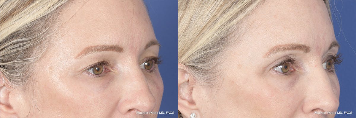 Brow Lift Before & After Gallery - Patient 160183 - Image 4