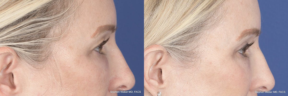 Brow Lift Before & After Gallery - Patient 160183 - Image 5