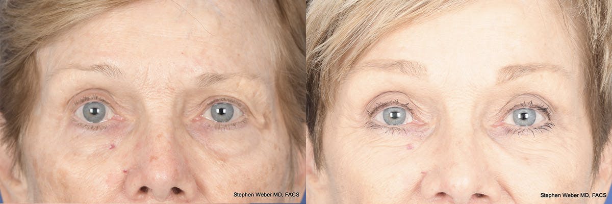 Brow Lift Before & After Gallery - Patient 148794 - Image 1