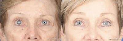 Brow Lift Before & After Gallery - Patient 148794 - Image 1
