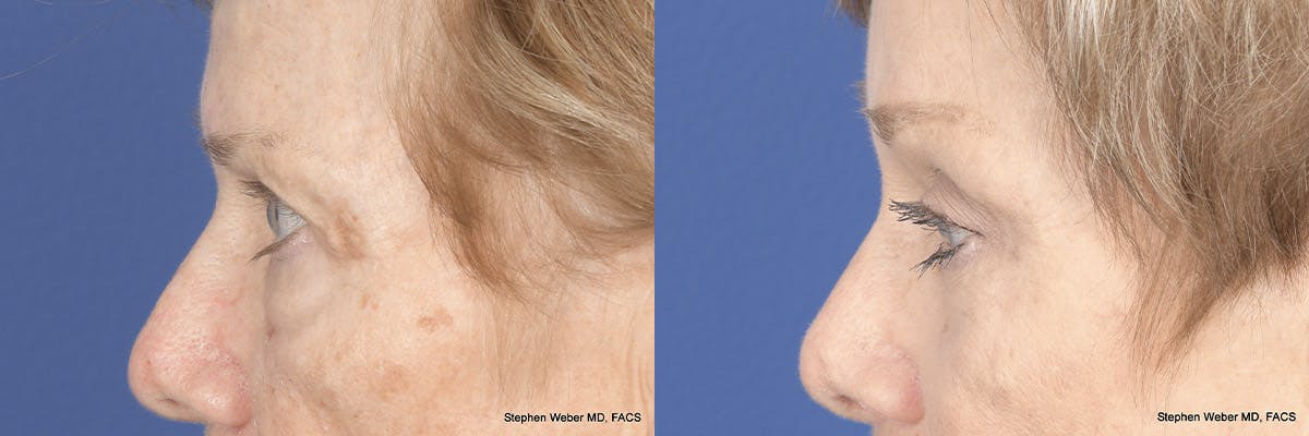 Brow Lift Before & After Gallery - Patient 148794 - Image 2