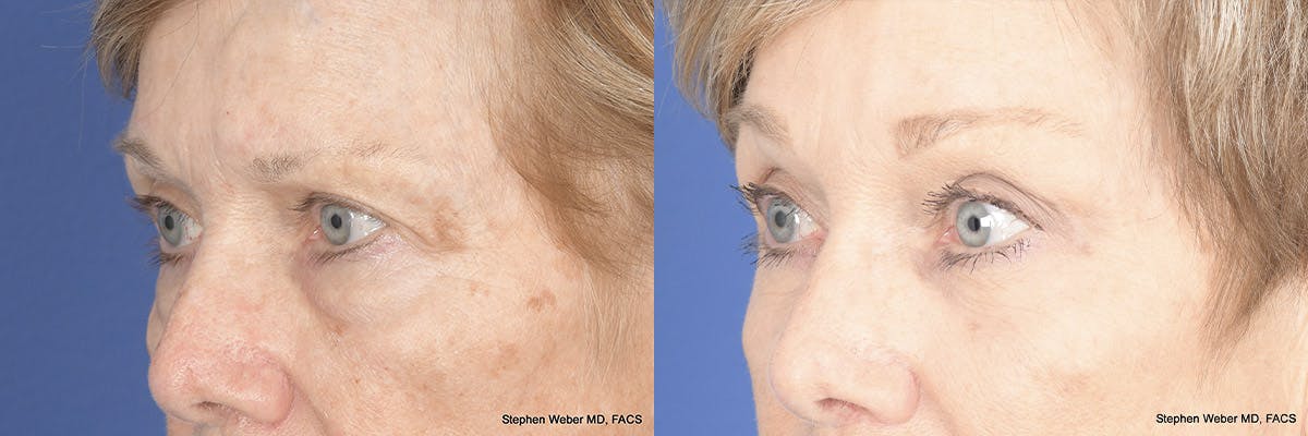 Brow Lift Before & After Gallery - Patient 148794 - Image 3