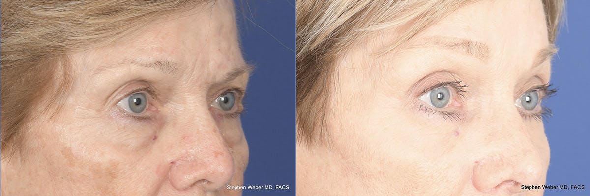 Brow Lift Before & After Gallery - Patient 148794 - Image 4