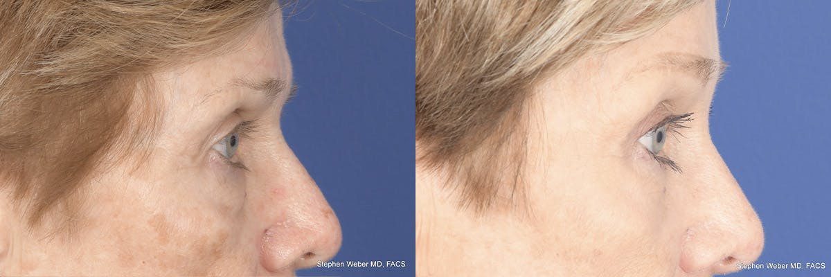 Brow Lift Before & After Gallery - Patient 148794 - Image 5