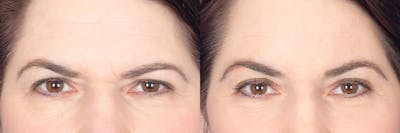 Brow Lift Before & After Gallery - Patient 340254 - Image 1