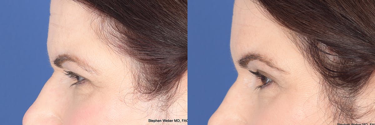Brow Lift Before & After Gallery - Patient 340254 - Image 2