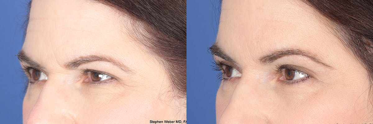 Brow Lift Before & After Gallery - Patient 340254 - Image 3