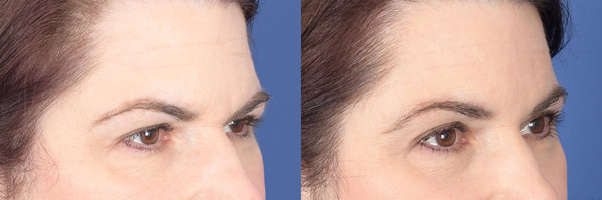 Brow Lift Before & After Gallery - Patient 340254 - Image 4