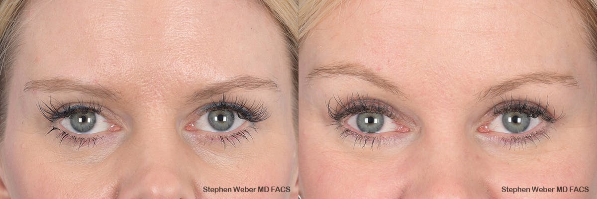 Brow Lift Before & After Gallery - Patient 354437 - Image 1