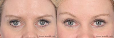 Brow Lift Before & After Gallery - Patient 354437 - Image 1
